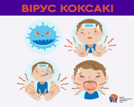Вірус Коксакі: симптоми і профілактика